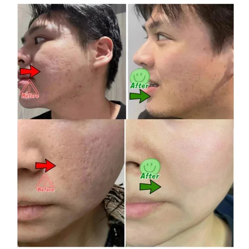 Salicylic Acid Pore Clearing C - Salicylic Acid Blackhead Remover review and price